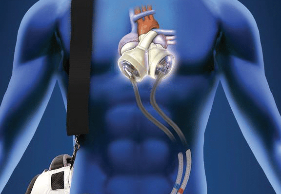 illustration of torso with artificial heart